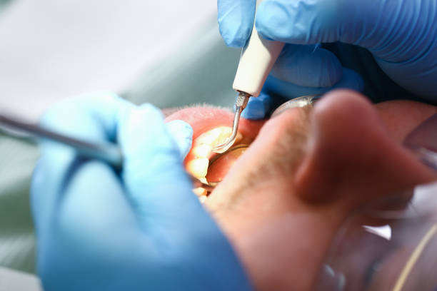 Best Emergency Gum Treatment in West Palm Beach, FL