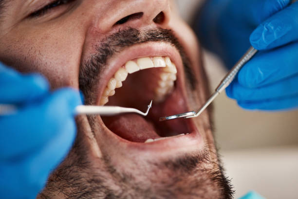Best Urgent Care for Lost Fillings or Crowns in West Palm Beach, FL